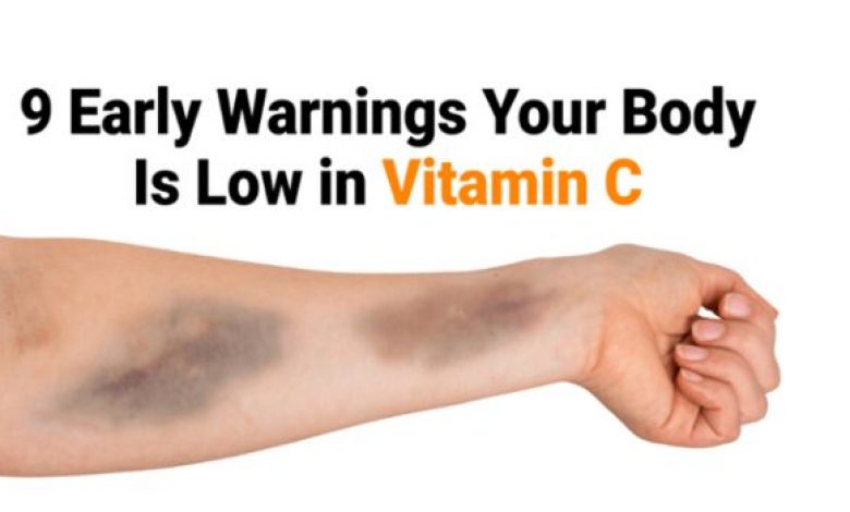 Signs of Vitamin C Deficiency