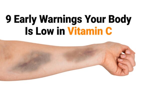 9 Early Warning Signs Your Body Is Low in Vitamin C Don’t Ignore!