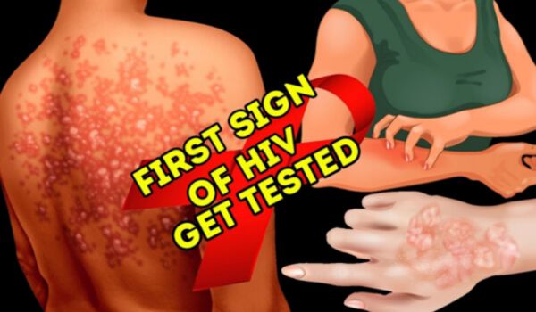 If You See These 13 Symptoms, Do An HIV Test Immediately!