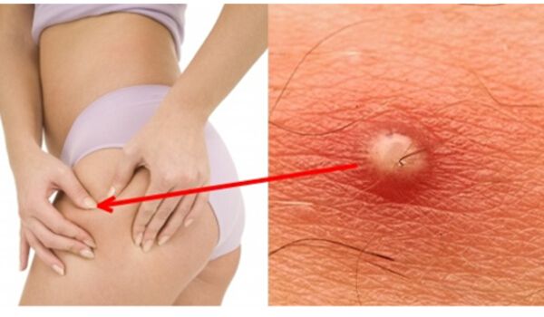 Home Remedies for Boils on Buttocks