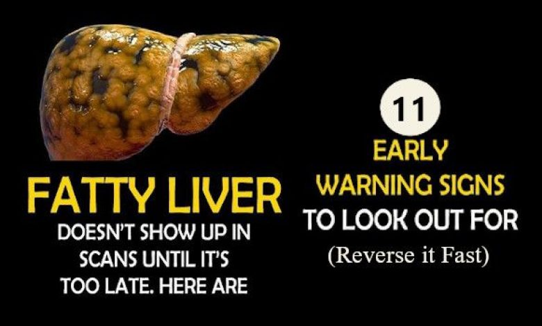 fatty liver disease