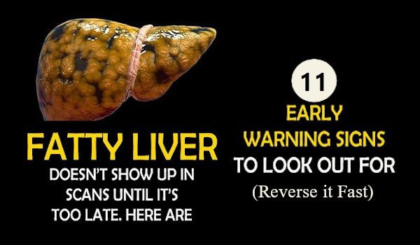 fatty liver disease