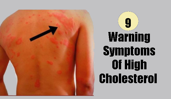 9 Symptoms Of High Cholesterol that You Shouldn’t Ignore!