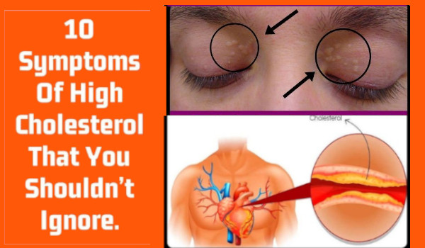 9 Symptoms Of High Cholesterol That You Shouldn T Ignore Right Home   High Cholesterol 