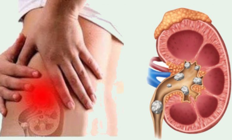 List of Foods that Cause Kidney Stones