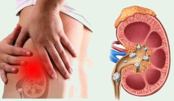 List of Foods that Cause Kidney Stones You should Avoid