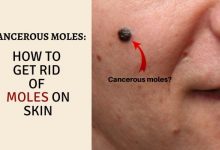Cancerous moles