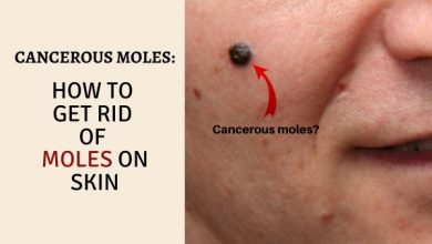Cancerous moles
