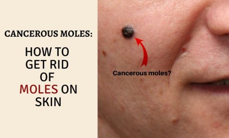 Cancerous moles