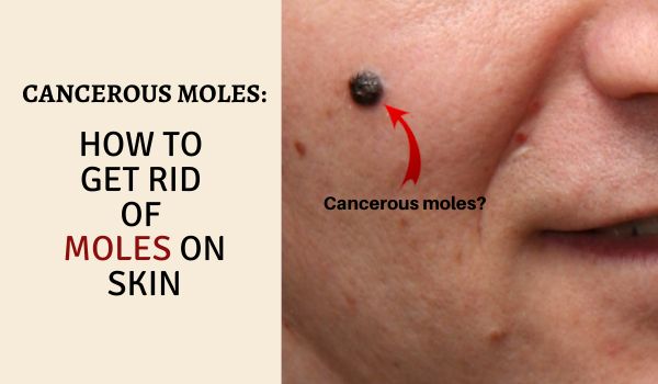 Cancerous Moles How To Get Rid Of Moles On Face Naturally 3087