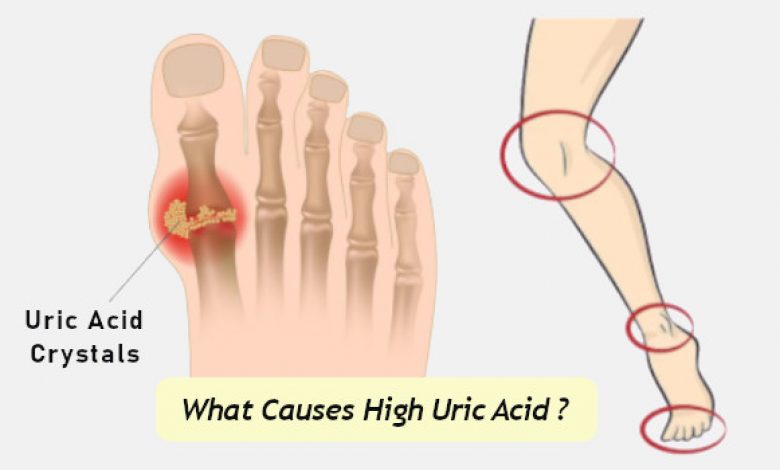 Symptoms and Causes of High Uric Acid Levels