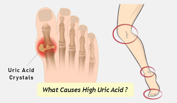 High Uric Acid Symptoms What Causes High Uric Acid Levels In The Body 4990