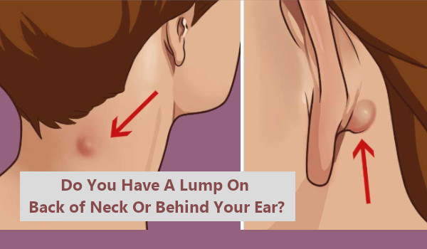 Lump On Back of Neck