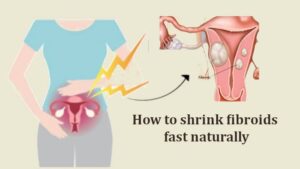 i shrink my fibroids naturally