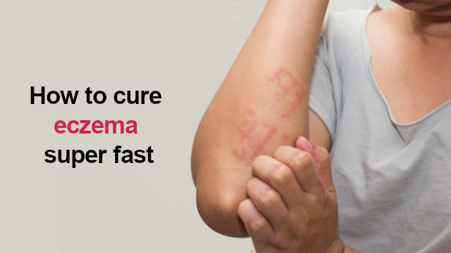 Itchy Eczema
