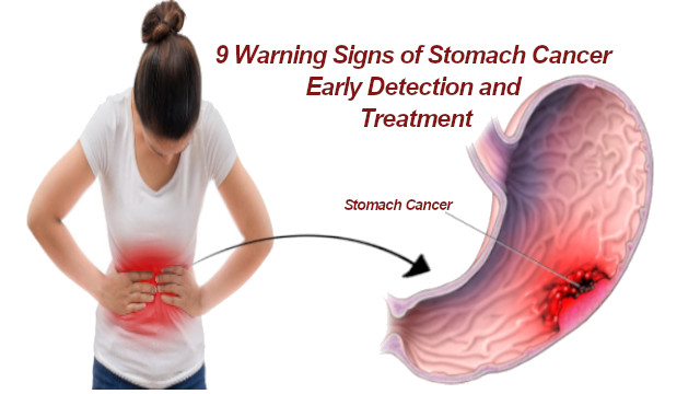 Signs of Stomach Cancer