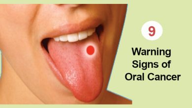 Warning Signs of Oral Cancer