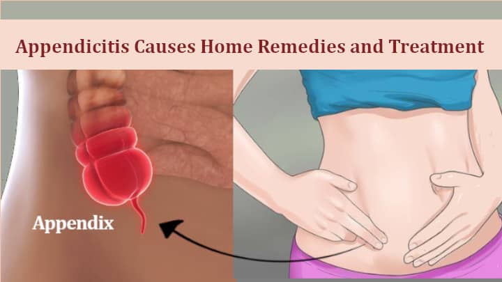 Appendicitis Causes Home Remedies and Treatment
