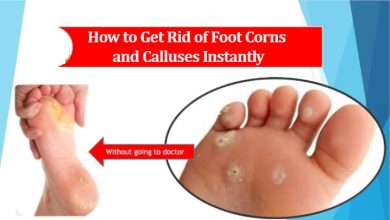 How to Get Rid of Foot Corns and Calluses