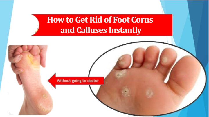 How to Get Rid of Foot Corns and Calluses