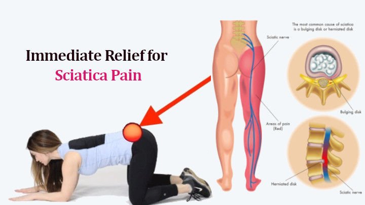 sciatic-nerve-pain-relief-how-to-treat-sciatica-nerve-pain-naturally