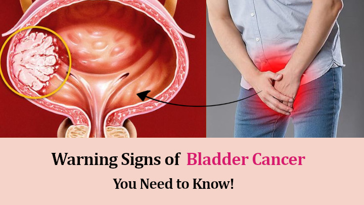 bladder cancer signs
