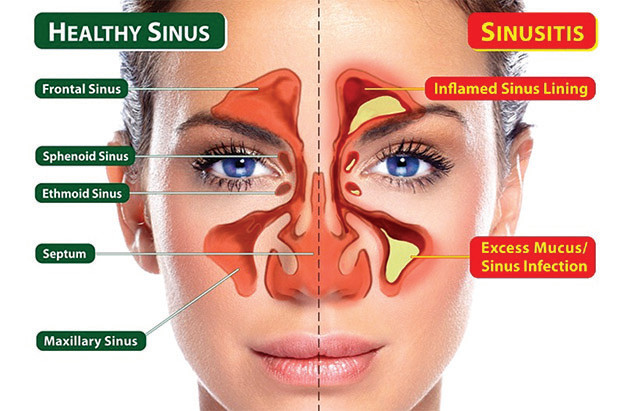 sinus headache