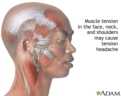 tension headache