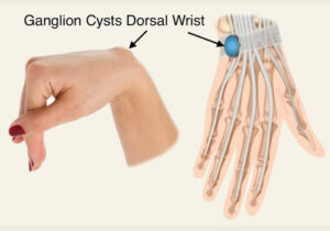 What is a Ganglion Cyst? Ganglion Cyst Removal without Surgery