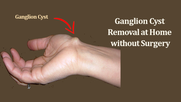 Ganglion Cyst Removal at Home