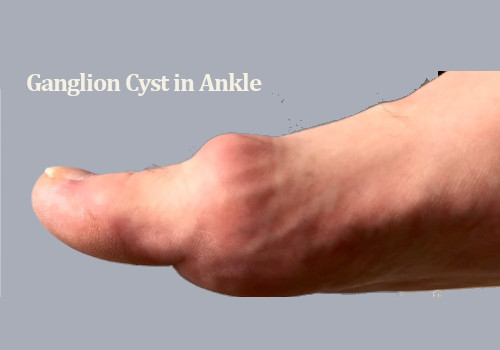 Ganglion Cyst Removal at Home