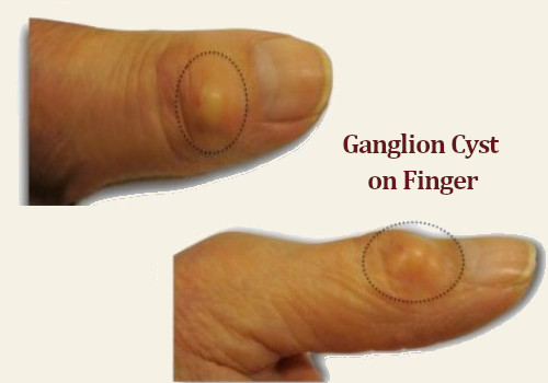 Ganglion Cyst On Finger Stock Photo Image Of Cyst