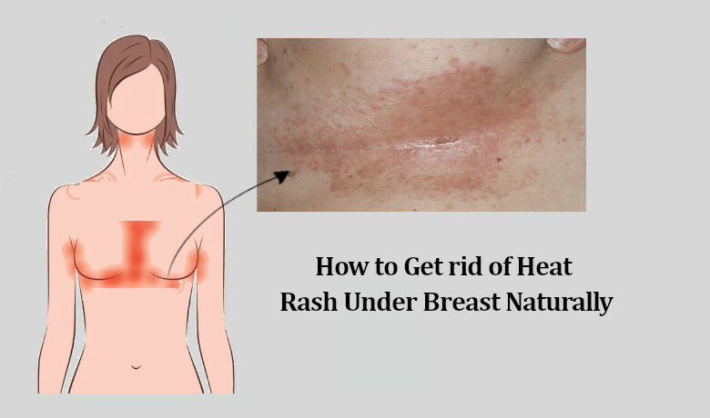 Heat Rash Under Breast