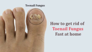 how to get rid of toe fungus fast at home