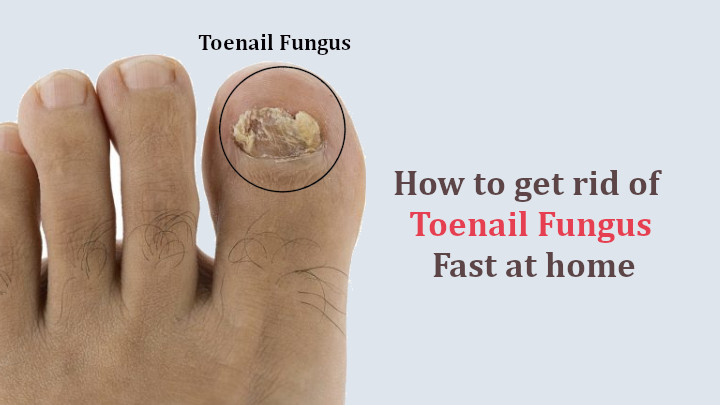 How to get rid of Toenail Fungus Fast at Home
