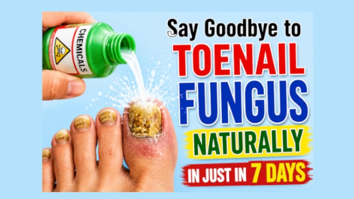 Say Goodbye to Toenail Fungus Naturally in Just In 7 Days