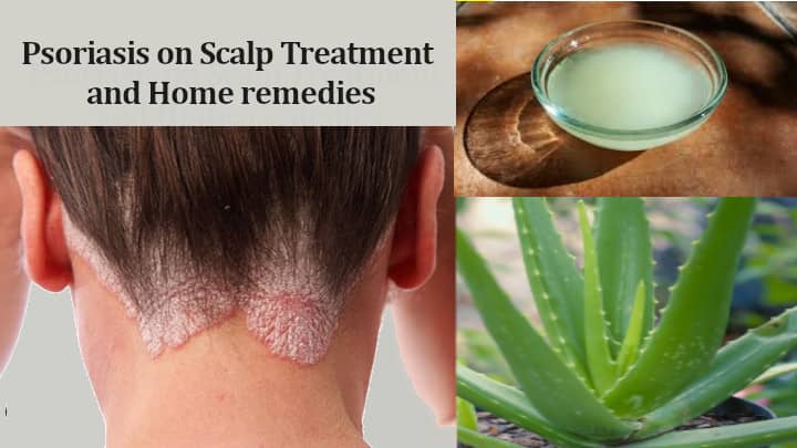 Psoriasis on Scalp Treatment and Home remedies