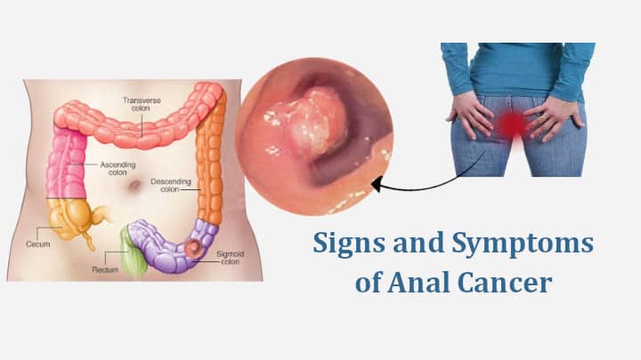 Signs and Symptoms of Anal Cancer