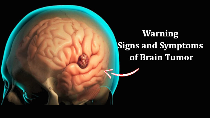 Signs and Symptoms of Brain Tumor