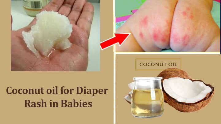 Coconut oil for Diaper Rash in Babies