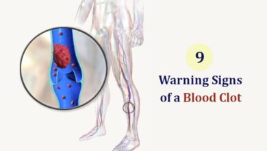 Signs of a Blood Clot