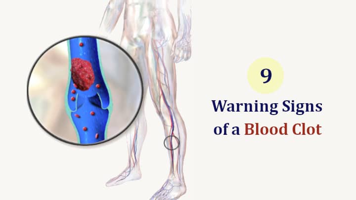 Signs of a Blood Clot