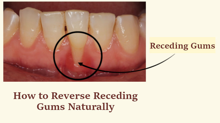How to Reverse Receding Gums Naturally
