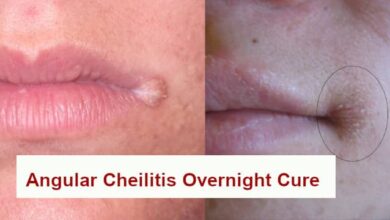 Angular Cheilitis Overnight Cure home remedy