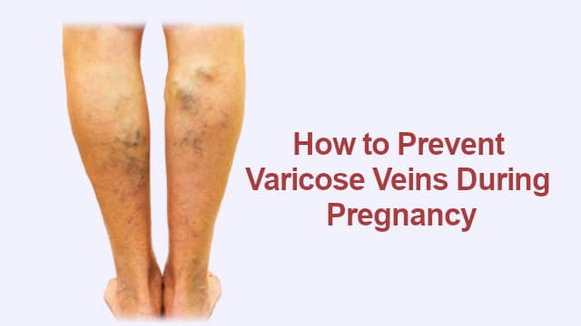 How to Prevent Varicose Veins During Pregnancy