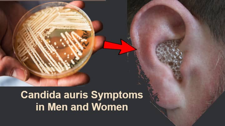 Candida auris Symptoms in Men and Women should never be ignored!