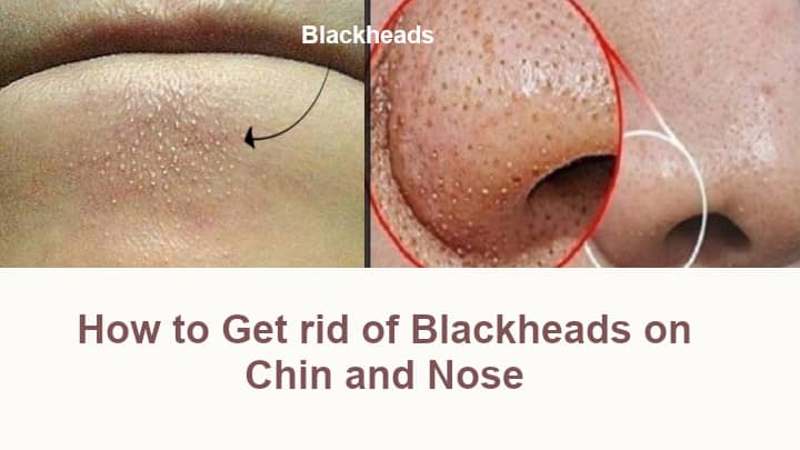 How to Get rid of Blackheads on Chin and Nose
