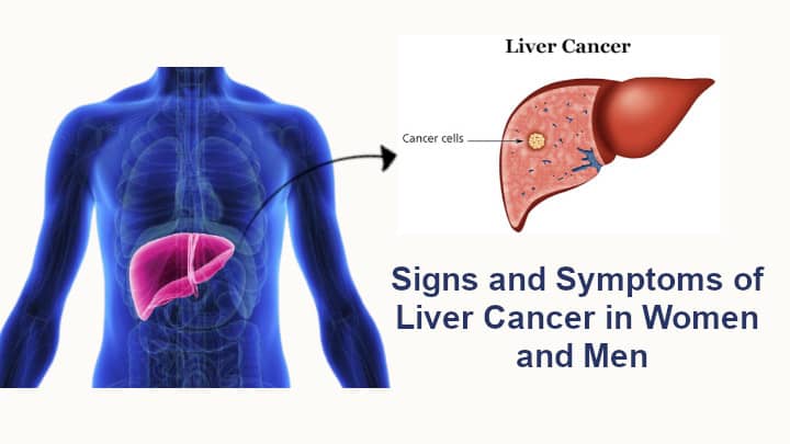 Signs and Symptoms of Liver Cancer in Women and Men