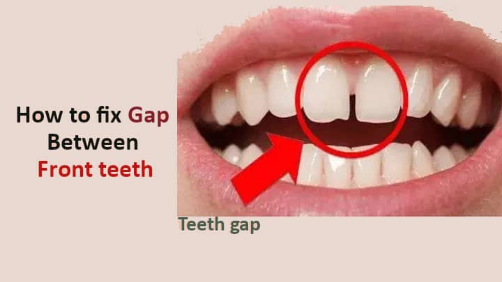 How to Fix Gap Between Front teeth
