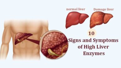 Signs and Symptoms of High Liver Enzymes10 Signs and Symptoms of High Liver Enzymes